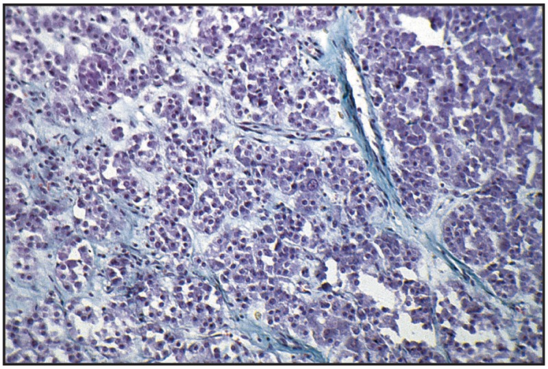 Fig. 12.24. Poorly differentiated carcinoma, prostate.