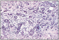 Fig. 12.25. Acinar carcinoma scirrhous with fibromuscular stroma, prostrate.