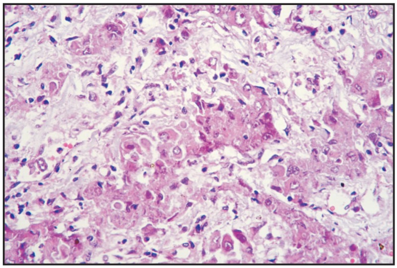 Fig. 12.30. Prostate carcinoma, metastasis in kidney.