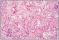 Fig. 10.10. Granulosa - theca cell tumor.