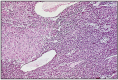 Fig. 10.12. Granulosa cell tumor with luteinization.