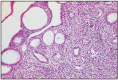 Fig. 10.17. Surface epithelial cysts.