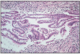 Fig. 10.19. Uterine carcinoma, infiltration of muscularis.