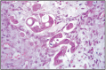 Fig. 10.20. Uterine adenocarcinoma.