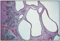 Fig. 10.21. Uterus cystic hyperplasia.