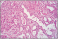 Fig. 10.3. Adenoma of subsurface epithelial structures.