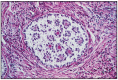 Fig. 10.9. Granulosa - theca cell tumor.