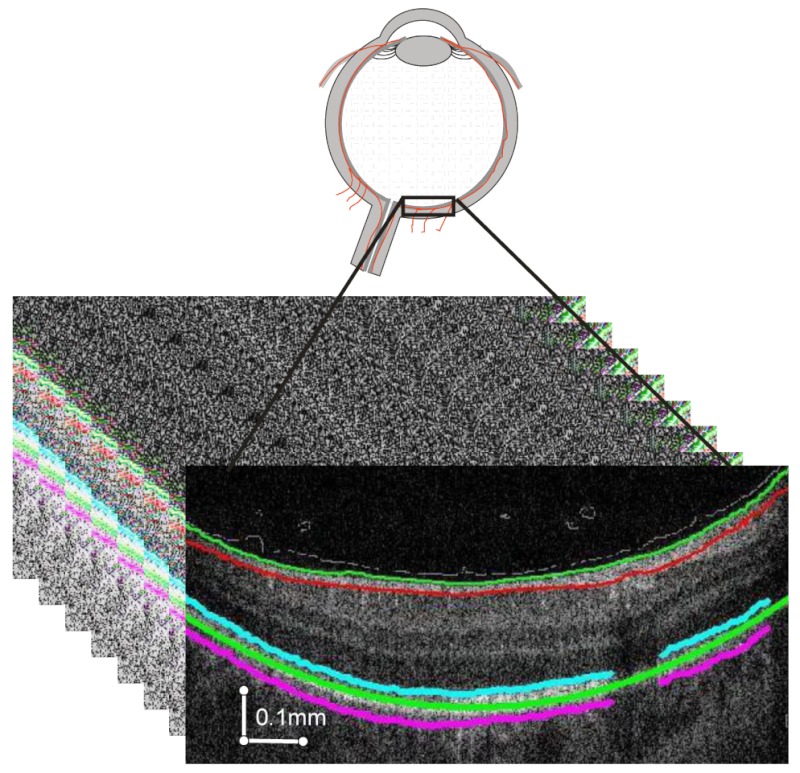 SEGMENT POSTERIOR - in ... OF EYE Processing Image ANALYSIS