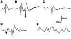 Figure 1. Interictal epileptic discharge (IED) patterns recorded in human partial epilepsies with intracranial electrodes.