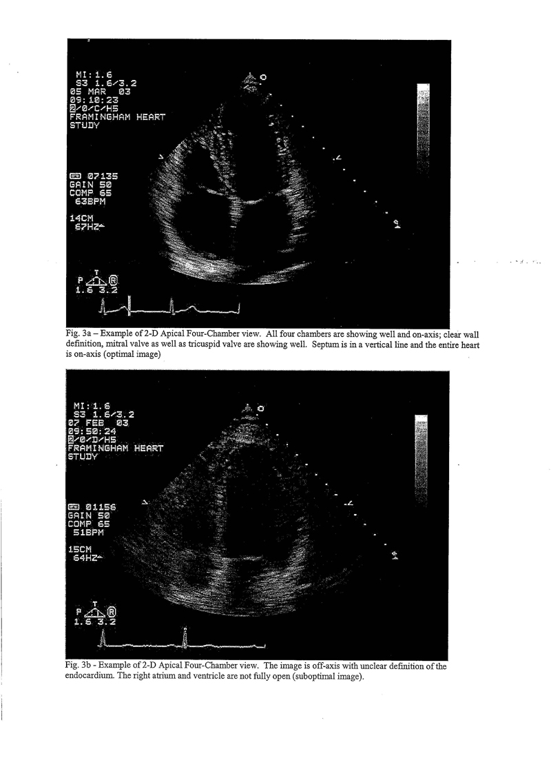 Selected video frame from a 2D echocardiogram in a parasternal