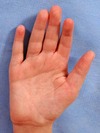 Palmar bilateral creases single Microphthalmia and