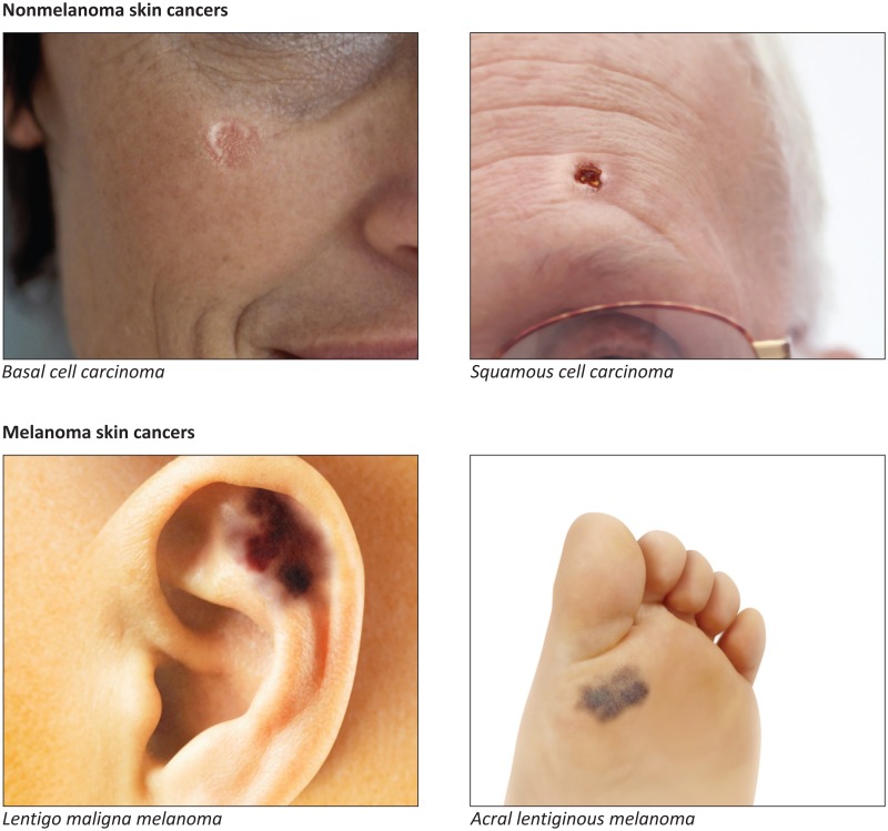 Figure 1 Types Of Skin Cancer The Surgeon General S Call To Action To Prevent Skin Cancer Ncbi Bookshelf