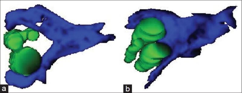 Figure 7. . Three-dimensional reconstructions of alopecia areata (a) and MAAs (b) demonstrating the loss of contact of the arrector pili muscle with the outer root sheath of the vellus hair follicle in MAA that is largely irreversible compared with maintenance of this contact of the arrector pili muscle with outer root sheath which is potentially completely reversible in alopecia area.