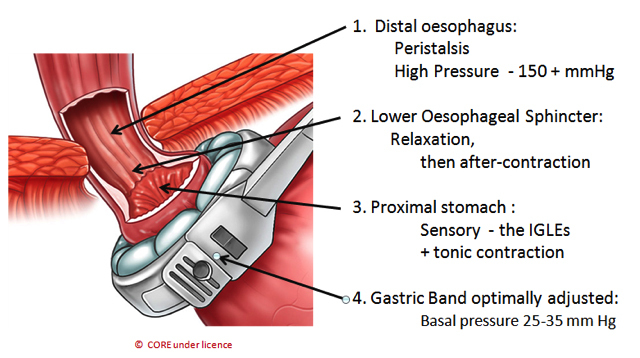 MiniMizer Adjustable Gastric Band - Bariatric Solutions: Bariatric Surgery