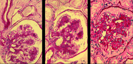 Figure 3. . Light microscopy photographs of glomeruli in sequential kidney biopsies performed at baseline and after 5 and 10 years of follow-up in a long-standing normoalbuminuric type 1 diabetic patient with progressive mesangial expansion and renal function deterioration.