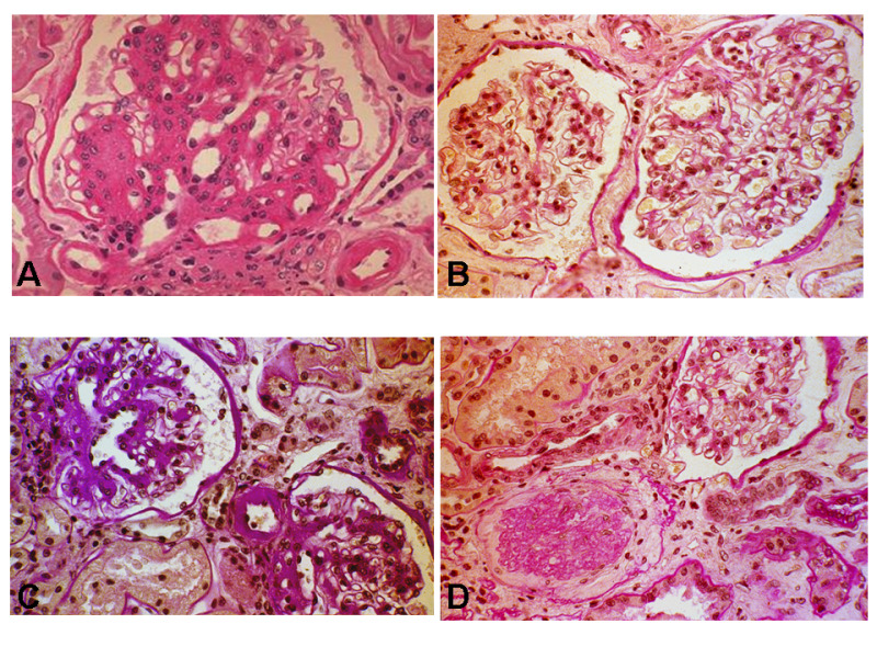Figure 5. . Light microscopy photographs of glomeruli of patients with type 1 (A) and type 2 diabetes (B-D).