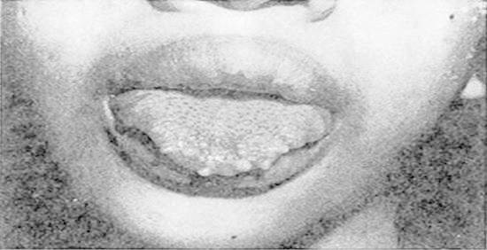 Figure 14. An 18-year-old female who demonstrates the appearance typically associated with multiple endocrine neoplasial type 2B (MEN2B) was found to have bilateral medullary carcinoma of the thyroid gland at surgery. Multiple neuromas of the tongue and lips are demonstrated. (Courtesy of Glen W. Sizemore.)