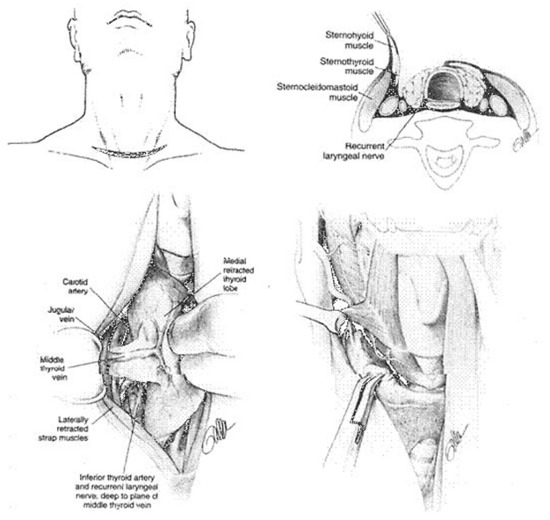 Figure 15. Upper left: Incision for thyroidectomy. The neck is extended and a symmetrical, gently curved incision is made 1 to 2 cm above the clavicle. In recent years, a much smaller incision is used except when a large goiter is present. Upper right: The sternohyoid and sternothyroid muscles are retracted to expose the surface of the thyroid lobe. Lower left: The surgeon’s hand retracts the gland anteriorly and medially to expose the posterior surfaces of the thyroid gland. The middle thyroid vein is identified, ligated and divided. Lower right: The superior thyroid vessels are ligated close to the thyroid capsule of the superior pole to avoid inadvertent injury to the external branch of the superior laryngeal nerve. This nerve can be seen in many cases.