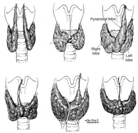 Figure 18. Variations of normal adult thyroid anatomy resulting from embryologic descent and division of the thyroid gland. (From Sedgwick CE, Cady B: Surgery of the Thyroid and Parathyroid Glands, 2d ed. Philadelphia, WB Saunders, 1980; adapted from Gray SW, Skandalakis JE: Embryology for Surgeons. Philadelphia, WB Saunders, 1972.)