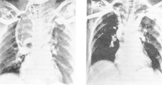 Figure 22. Large substernal goiter resulting in superior vena caval syndrome. Left , A venogram demonstrated complete obstruction of the superior vena cava, displacement of the innominate veins, and marked collateral circulation. Right , Three weeks after thyroidectomy, patency of the vena cava was restored. Some displacement of the innominate veins remained at that time. (From Lesavoy MA, Norberg HP, Kaplan EL: Substernal goiter with superior vena caval obstruction. Surgery 77:325–329, 1975.)