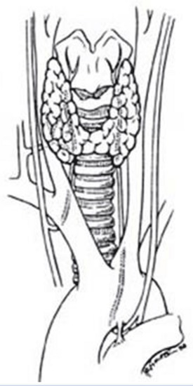 Figure 4a. Anatomy of the recurrent laryngeal nerves. (From Thompson NW, Demers M: Exposure is not necessary to avoid the recurrent laryngeal nerve during thyroid operations. In Simmons RL, Udekwu AO [eds, Debates in Clinical Surgery, Chicago, Year Book Publishers, 1990.)