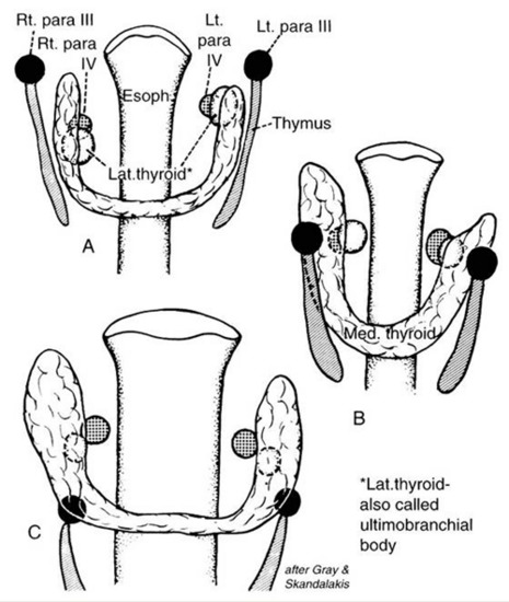 Figure 7. A and B, Shifts in location of the thyroid, parafollicular, and parathyroid tissues. C, approximates the adult location. Note that what has been called the lateral thyroid is now commonly referred to as the ultimobranchial body, which contains both C cells and follicular elements. (From Sedgwick CE, Cady B: Surgery of the Thyroid and Parathyroid Gland, 2nd ed. Philadelphia, WB Saunders, 1980; adapted from Norris EH: Parathyroid glands and lateral thyroid in man: Their morphogenesis, histogenesis, topographic anatomy and prenatal growth. Contrib Embryol Carnegie Inst Wash 26:247–294, 1937.) Principles of Surgery, 5th ed. New York, McGraw-Hill, 1989, pp 1613–1685. Copyright © by McGraw-Hill, Inc. Used by permission of McGraw-Hill Book Company.)”]