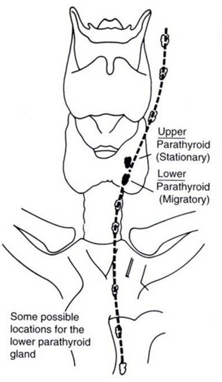 Figure 8. Descent of the lower parathyroid. Whereas the upper parathyroid occupies a relatively constant position in relation to the middle or upper third of the lateral thyroid lobe, the lower parathyroid normally migrates in embryonic life and may end up anywhere along the course of the dotted line. When this gland is in the chest, it is nearly always in the anterior mediastinum. (From Kaplan EL: Thyroid and parathyroid. In: Principles of Surgery, Schwartz SI [ed], 6th edition, Chpt 36, McGaw-Hill, Inc., New York, NY, 1993, pp 1611-1680).