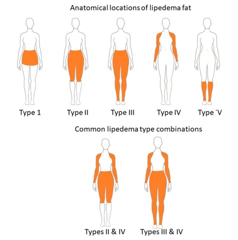 Lipedema: Abnormal female fat that just won't go away Overview